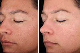 Best Sunekos Injections in Islamabad
