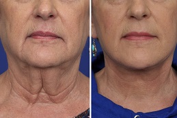 Best Ultherapy Treatment in Islamabad