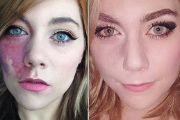 Birthmark Removal in Islamabad