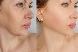 Botox Injections Clinic in Islamabad