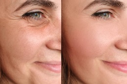 Botox Injections in Islamabad