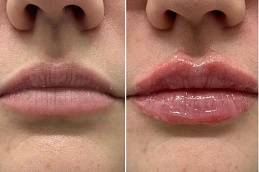 Botox Lip Flip Clinic in Islamabad
