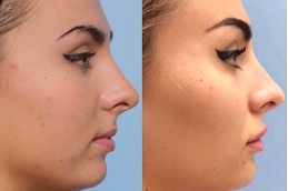 Cheek Fillers Injections in Islamabad