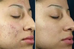 Chemical peels Clinic in Islamabad