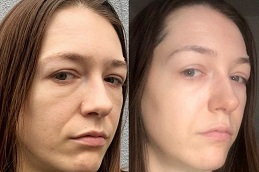 Chemical peels in Islamabad