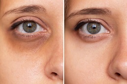 Dark Circles Treatment Clinic in Islamabad