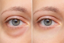 Dark Circles Treatment in Islamabad