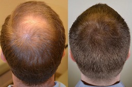 FUE Hair Transplant Clinic in Islamabad