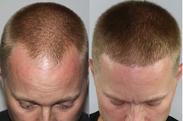 FUE Hair Transplant in Islamabad