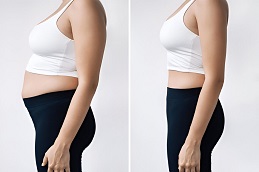 Fat Reduction Clinic in Islamabad