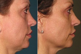 HIFU Treatment Clinic in Islamabad