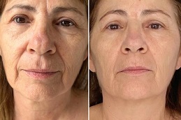 HIFU Treatment in Islamabad