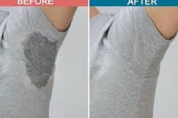 Hyperhidrosis Treatment in Islamabad