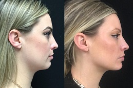  Jawline Fillers Clinic in Islamabad
