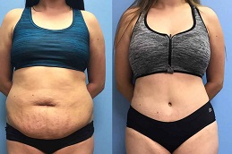 Laser Liposuction Clinic in Islamabad