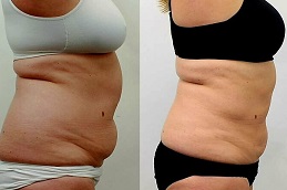 Laser Liposuction in Islamabad