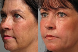 Laser Skin Tightening Clinic in Islamabad