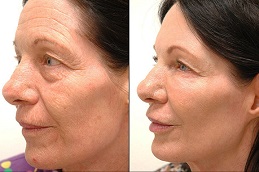 Laser Skin Tightening in Islamabad