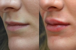 Lip Tinting Clinic in Islamabad