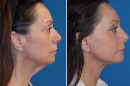 Mesotherapy Treatment Clinic in Islamabad