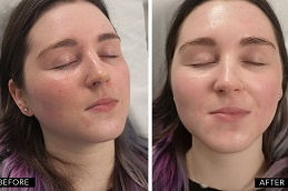 Mesotherapy Treatment in Islamabad
