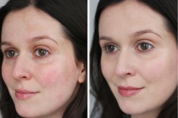 Microneedling Treatment Clinic in Islamabad