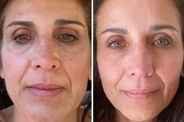 Microneedling Treatment in Islamabad