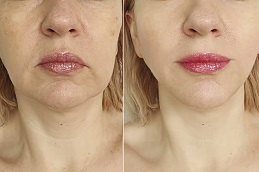 PDO thread lift Clinic in Islamabad