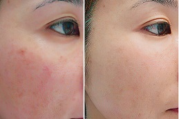 Rosacea Treatment Clinic in Islamabad