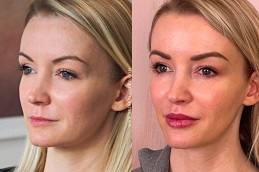 Sculptra Fillers Clinic in Islamabad