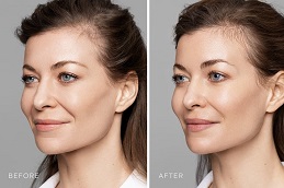Sculptra Fillers in Islamabad