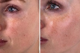 Skin Booster Injections in Islamabad