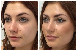Sunekos Injections Clinic in Islamabad