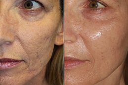Sunekos Injections in Islamabad