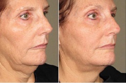 Ultherapy Treatment Clinic in Islamabad