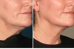 Ultherapy Treatment in Islamabad
