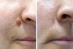 Mole Removal in Islamabad & Pakistan