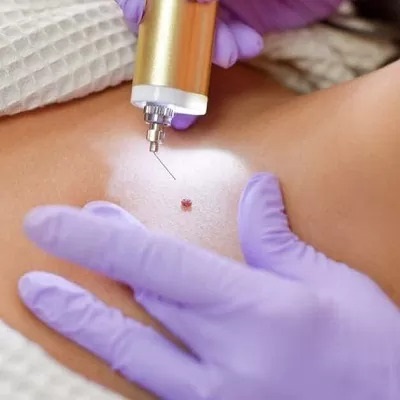 Laser wart removal procedure on skin at Capella Esthetics Islamabad